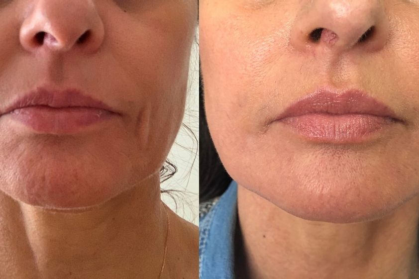 Lipofilling avant et après - 870383
