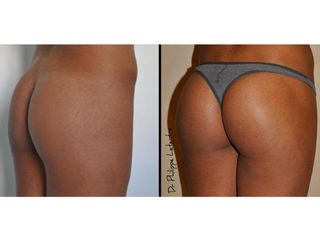 Avant après Chirurgie des fessiers