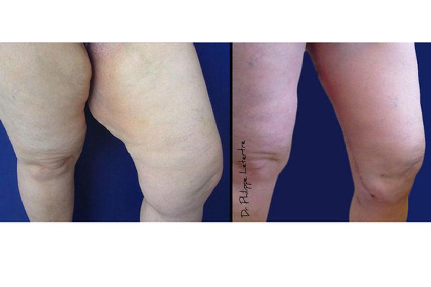 Bodylift avant et après - 542944