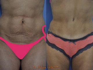 Avant après Abdominoplastie