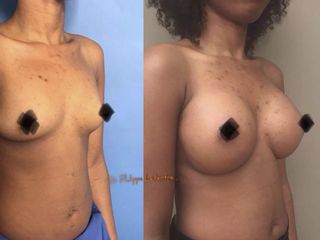 Avant après Implants mammaires