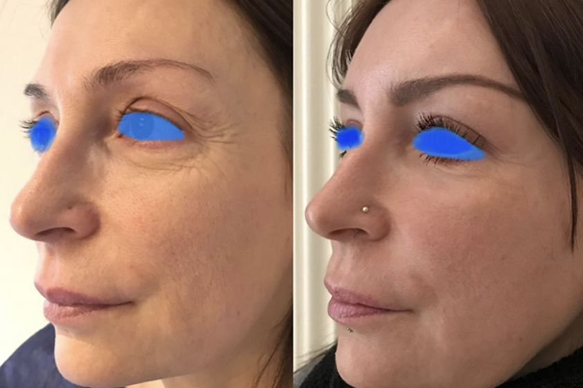 Lipofilling avant et après - 629994