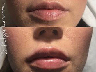 Augmentation des lèvres-629998
