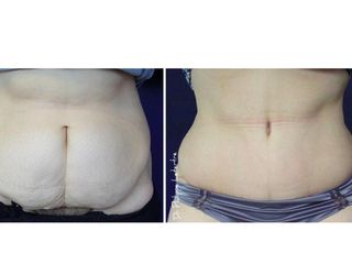 Avant après Abdominoplastie