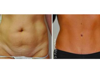 Avant après Abdominoplastie