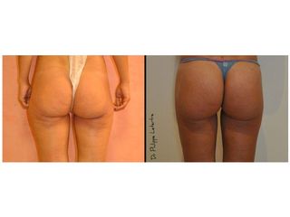 Avant après Chirurgie des fessiers