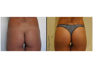 Avant après Chirurgie des fessiers