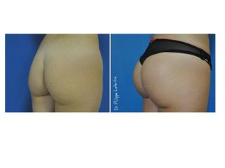 Avant après Chirurgie des fessiers