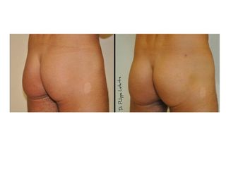 Avant après Chirurgie des fessiers
