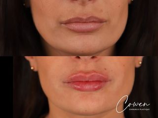 Augmentation des lèvres - Dr Maxime Cowen