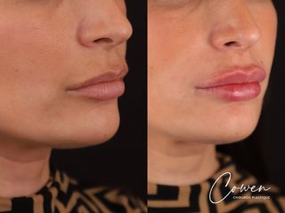 Augmentation des lèvres - Dr Maxime Cowen