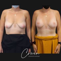 Augmentation mammaire - Dr Maxime Cowen