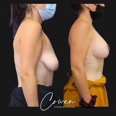 Mastopexie - Dr Maxime Cowen
