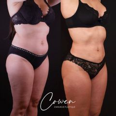Liposuccion - Dr Maxime Cowen
