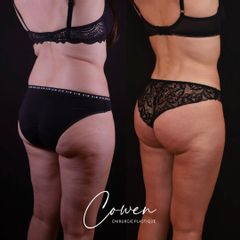 Liposuccion - Dr Maxime Cowen