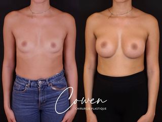 Augmentation mammaire - Dr Maxime Cowen