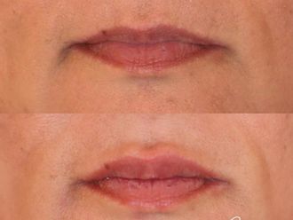 Augmentation des lèvres - 854851