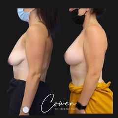 Mastopexie - Dr Maxime Cowen