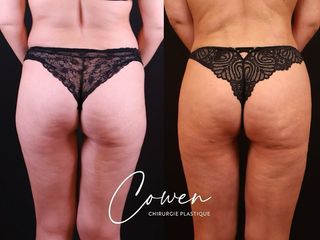 Liposuccion - Dr Maxime Cowen