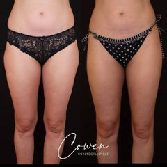 Liposuccion - Dr Maxime Cowen