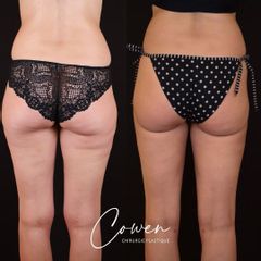Liposuccion - Dr Maxime Cowen