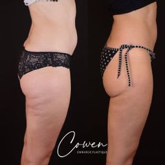 Liposuccion - Dr Maxime Cowen