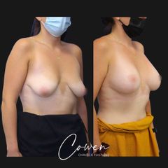 Augmentation mammaire - Dr Maxime Cowen