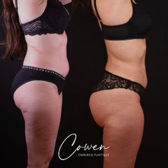 Liposuccion - Dr Maxime Cowen