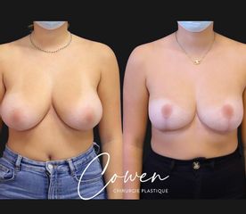 Mastopexie - Dr Maxime Cowen