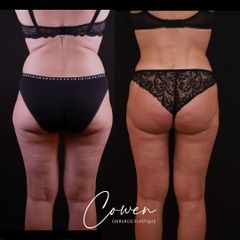Liposuccion - Dr Maxime Cowen