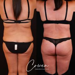 Abdominoplastie - Dr Maxime Cowen