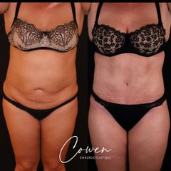 Abdominoplastie - Dr Maxime Cowen