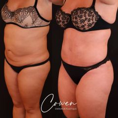 Abdominoplastie - Dr Maxime Cowen