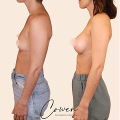 Augmentation mammaire - Dr Maxime Cowen