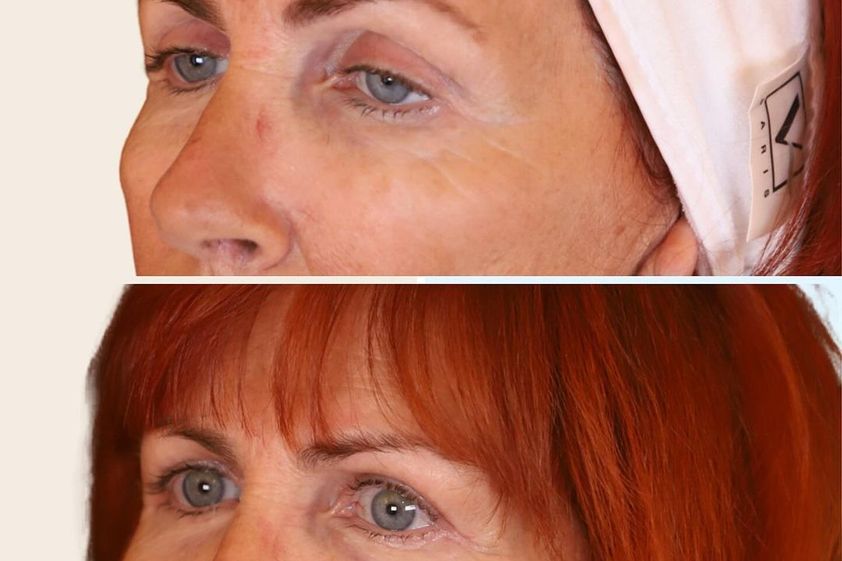 Blépharoplastie avant et après - 865908