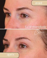 Blépharoplastie - Dr Maxime Cowen