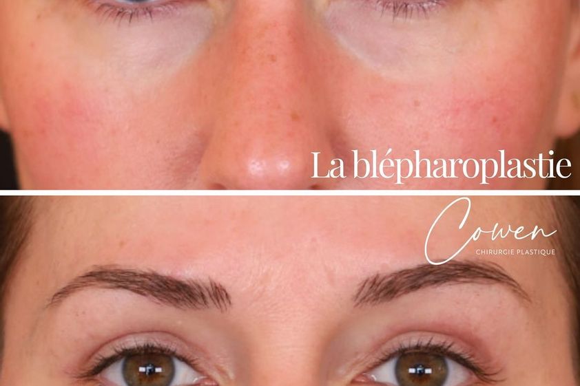 Blépharoplastie avant et après - 870120