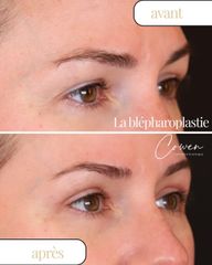 Blépharoplastie - Dr Maxime Cowen