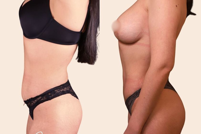Liposuccion avant et après - 870122