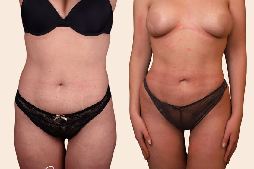 Liposuccion avant et après - 870124