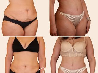 Abdominoplastie avant et après - 870127