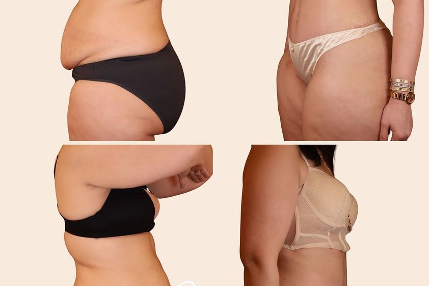 Abdominoplastie avant et après - 870128