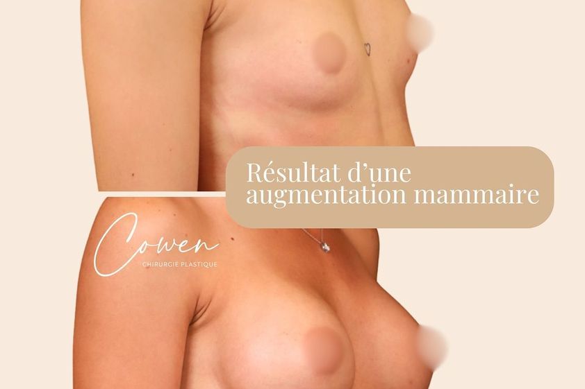 Augmentation mammaire avant et après - 870130