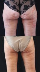 Cryo culotte de cheval - Dr Pierre-Alain Mayeux