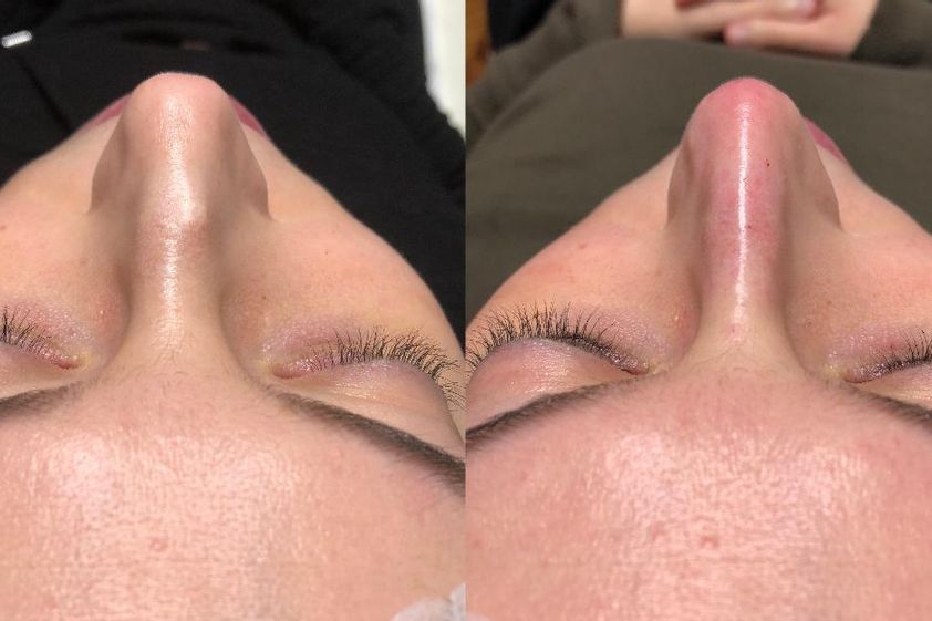 Rhinoplastie médicale avant et après - 834871