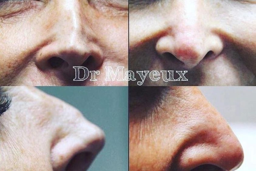 Rhinoplastie avant et après - 835282