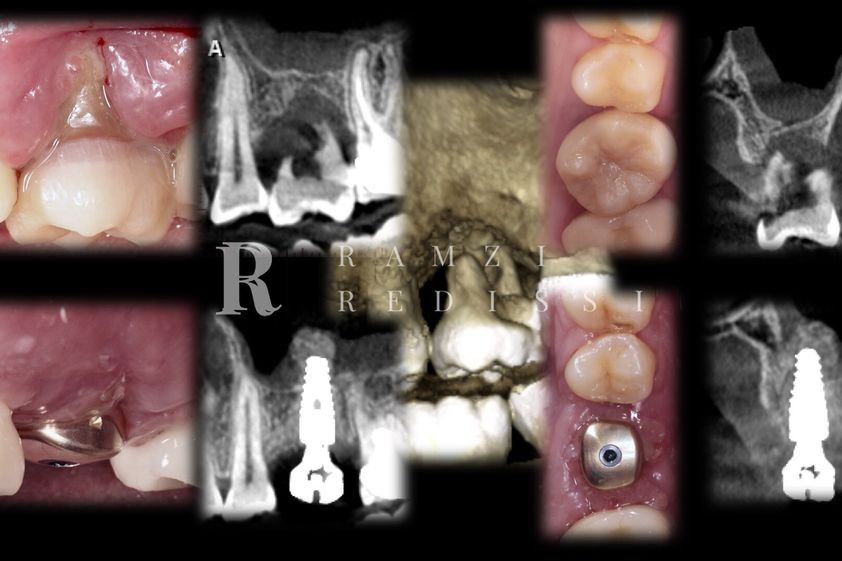 Implants dentaires avant et après - 850105