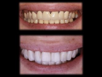 Blanchiment des dents - 850107