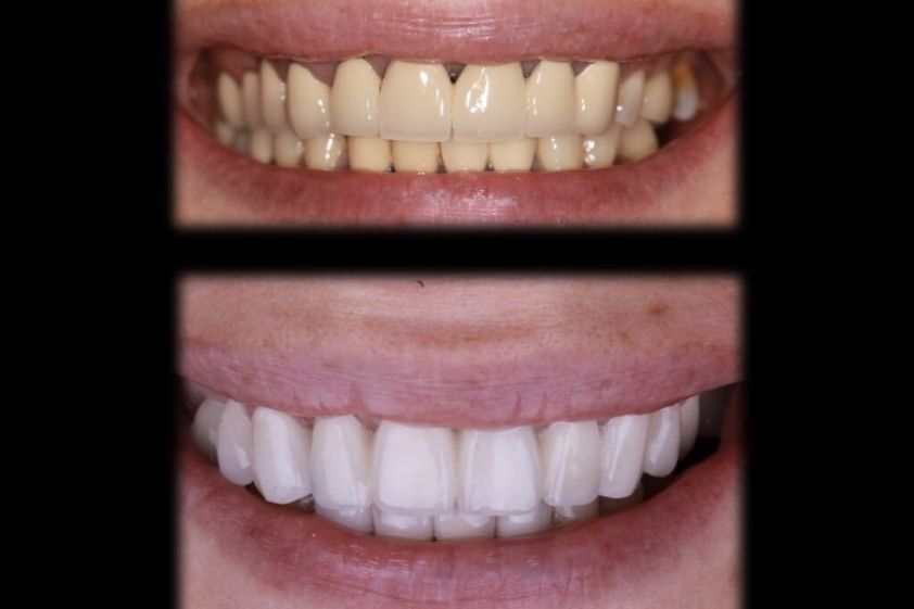 Blanchiment des dents avant et après - 850107