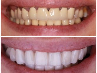 Blanchiment des dents - 851245